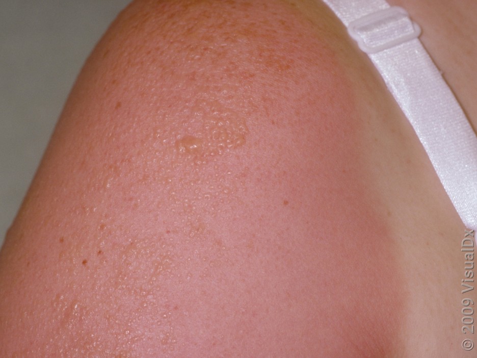 A shoulder with redness and blistering from sun poisoning.