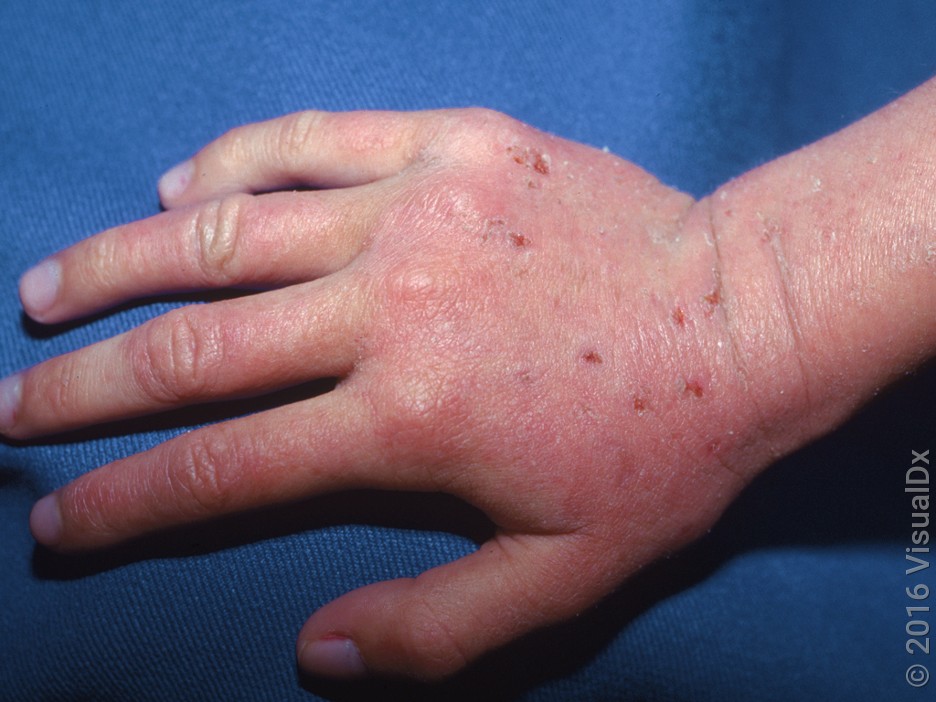 Hand Fungus vs. Eczema: How to Tell the Difference (With Photos) - GoodRx