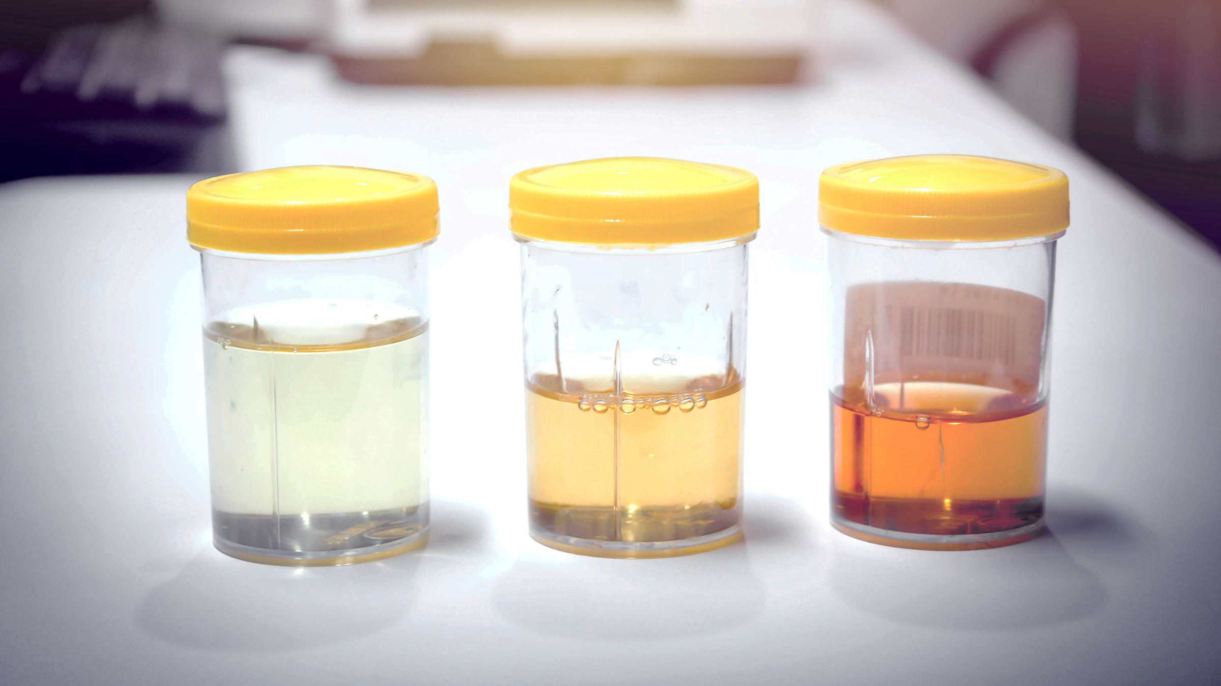 What Makes Urine Dark Color