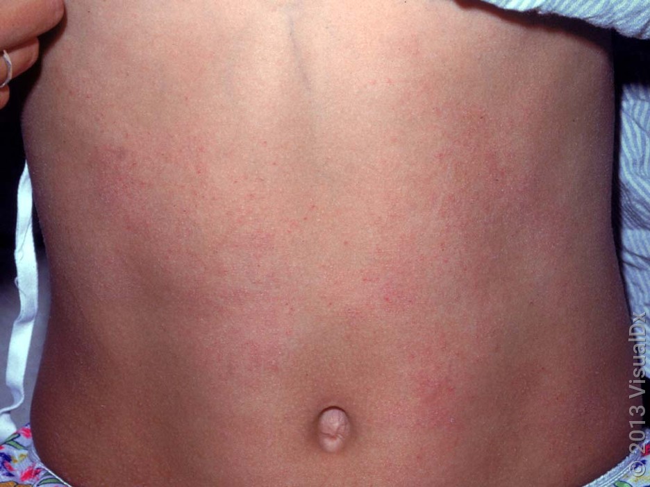Many tiny, faint, pink papules on the skin of the abdomen in swimmer’s itch. 