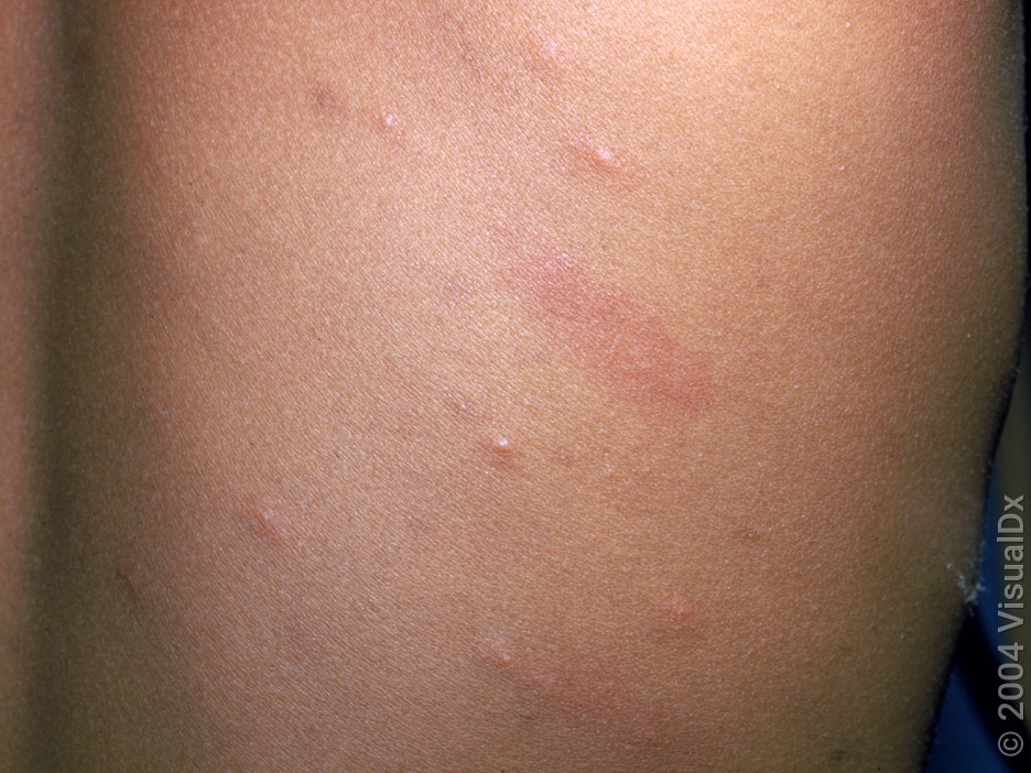 Close-up of early stages of chickenpox. 