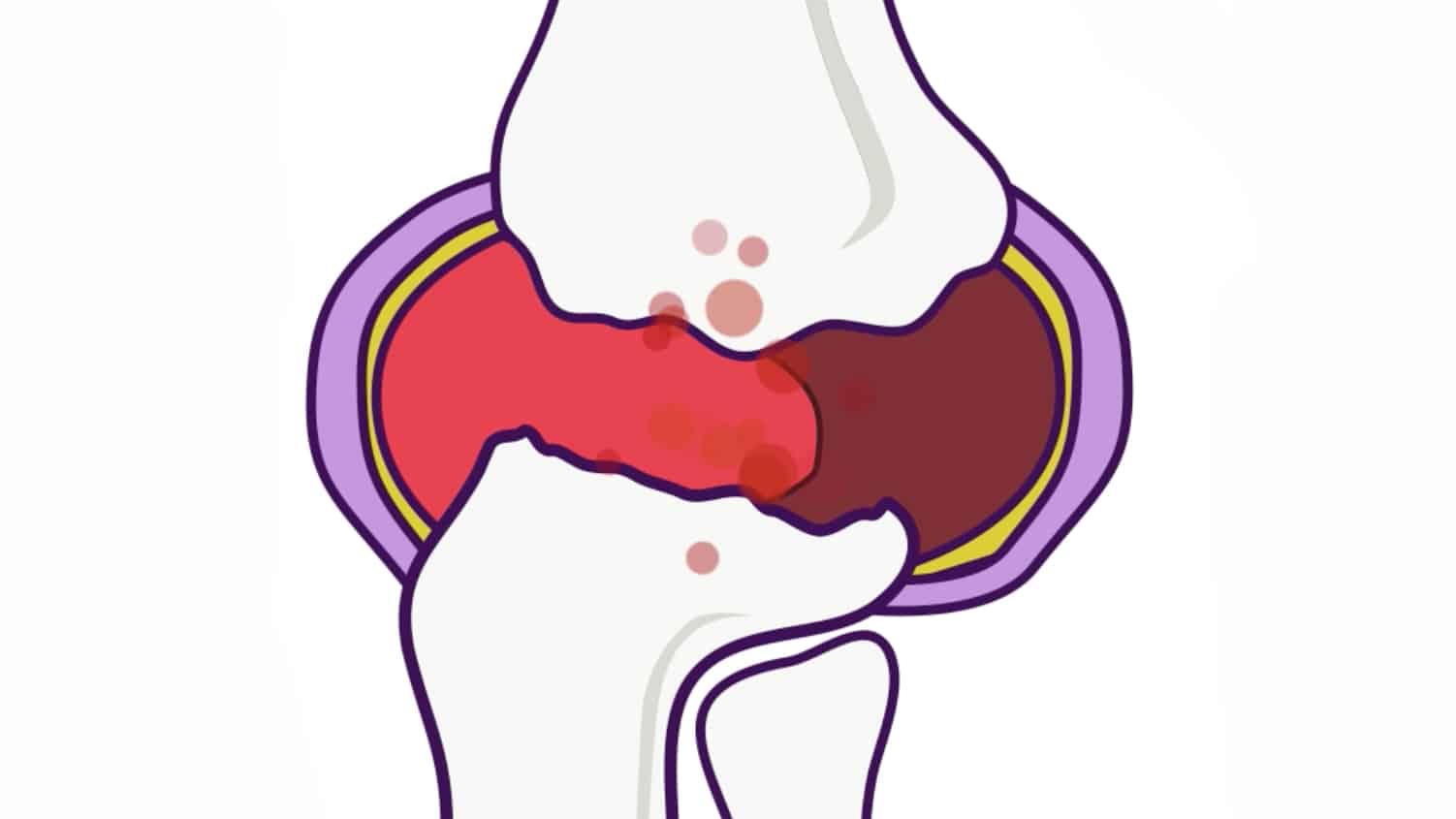 Complications of Rheumatoid Arthritis What Is Joint Erosion? GoodRx