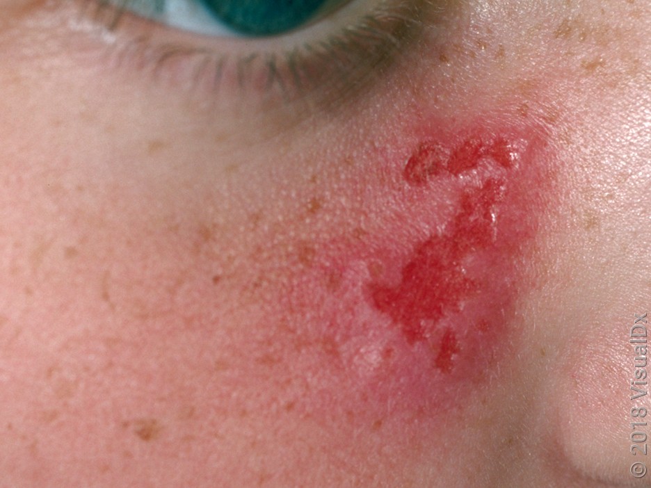 Close-up of open sores from herpes on the cheek.