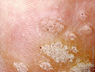 6 Pictures Of Warts And How To Treat Different Types GoodRx