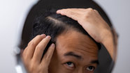 Oral Minoxidil For Hair Loss How Low Doses Can Fight Hair Loss GoodRx