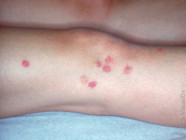 Close Up Pictures Of Bedbug Bites And Signs To Watch For GoodRx Close Up Pictures Of Bedbug Bites And Signs To Watch For GoodRx