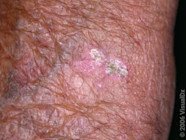 Actinic Keratosis Images Symptoms And Treatment GoodRx
