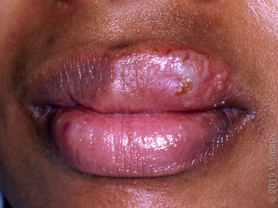 Close-up of blisters on the upper lip.