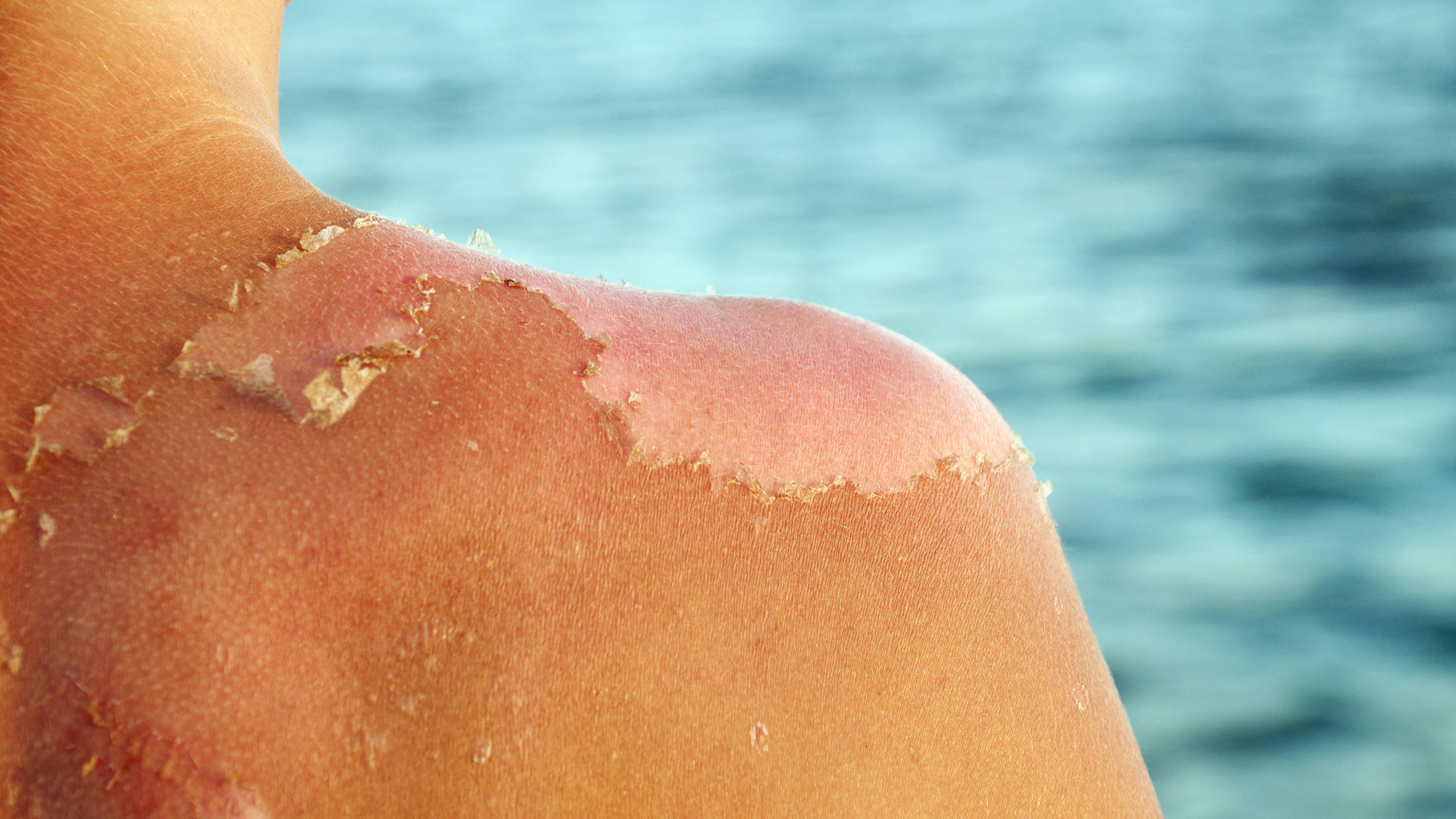 Sunburn Vs. Sun Poisoning Symptoms Treatment Risks More GoodRx