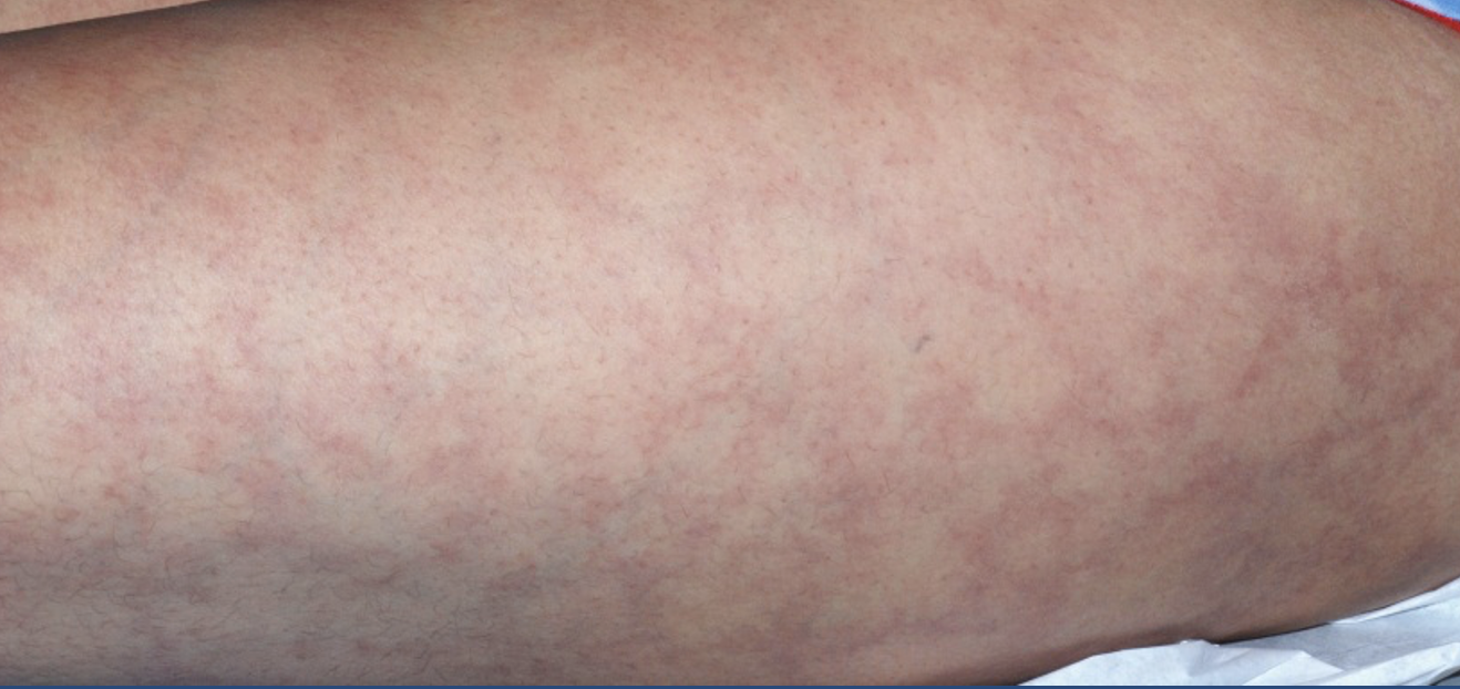 Lupus Rash: What It Is and How to Treat It - GoodRx