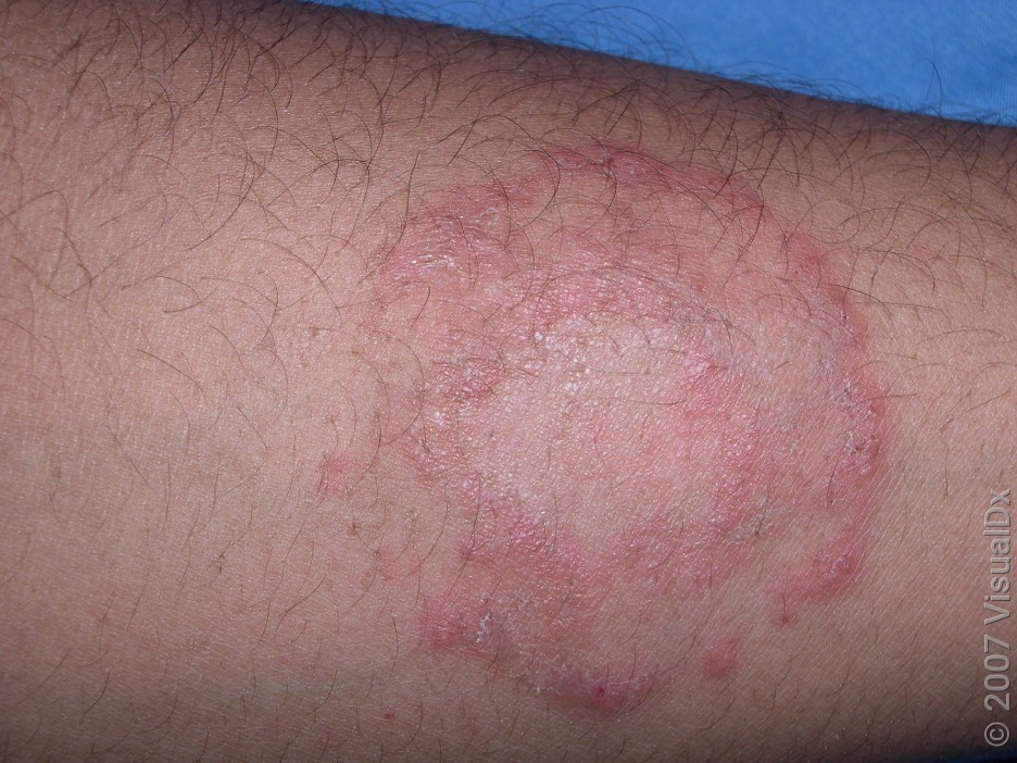 Close-up of ringworm on the arm. 
