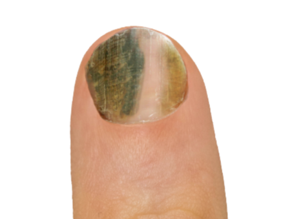 Nail Matrix: What It Is, Function, Damage & Conditions