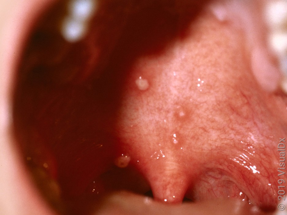 Chickenpox blisters inside the mouth. 