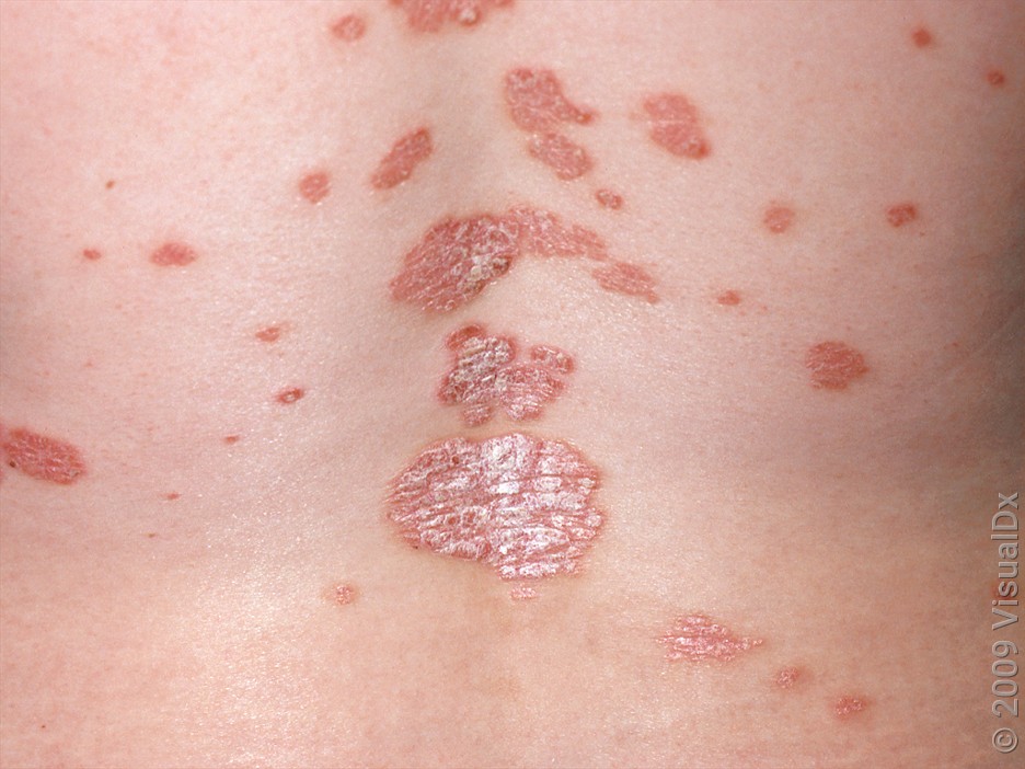Close-up of psoriasis on the back. 