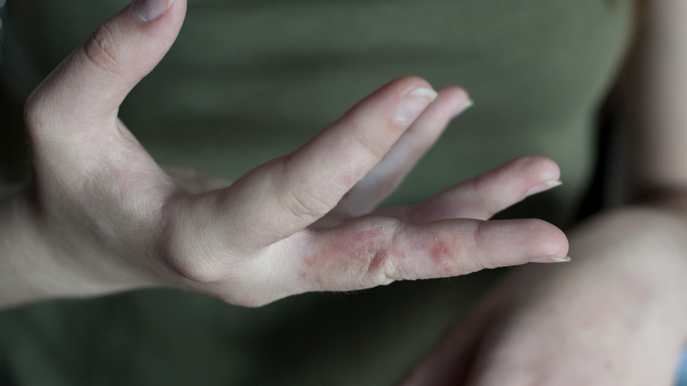 What Is the Difference Between Hand Fungus and Eczema? - GoodRx