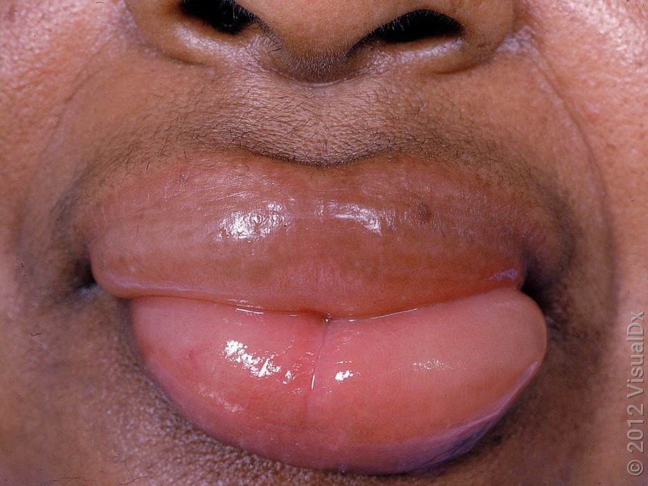 Angioedema of the lips. 