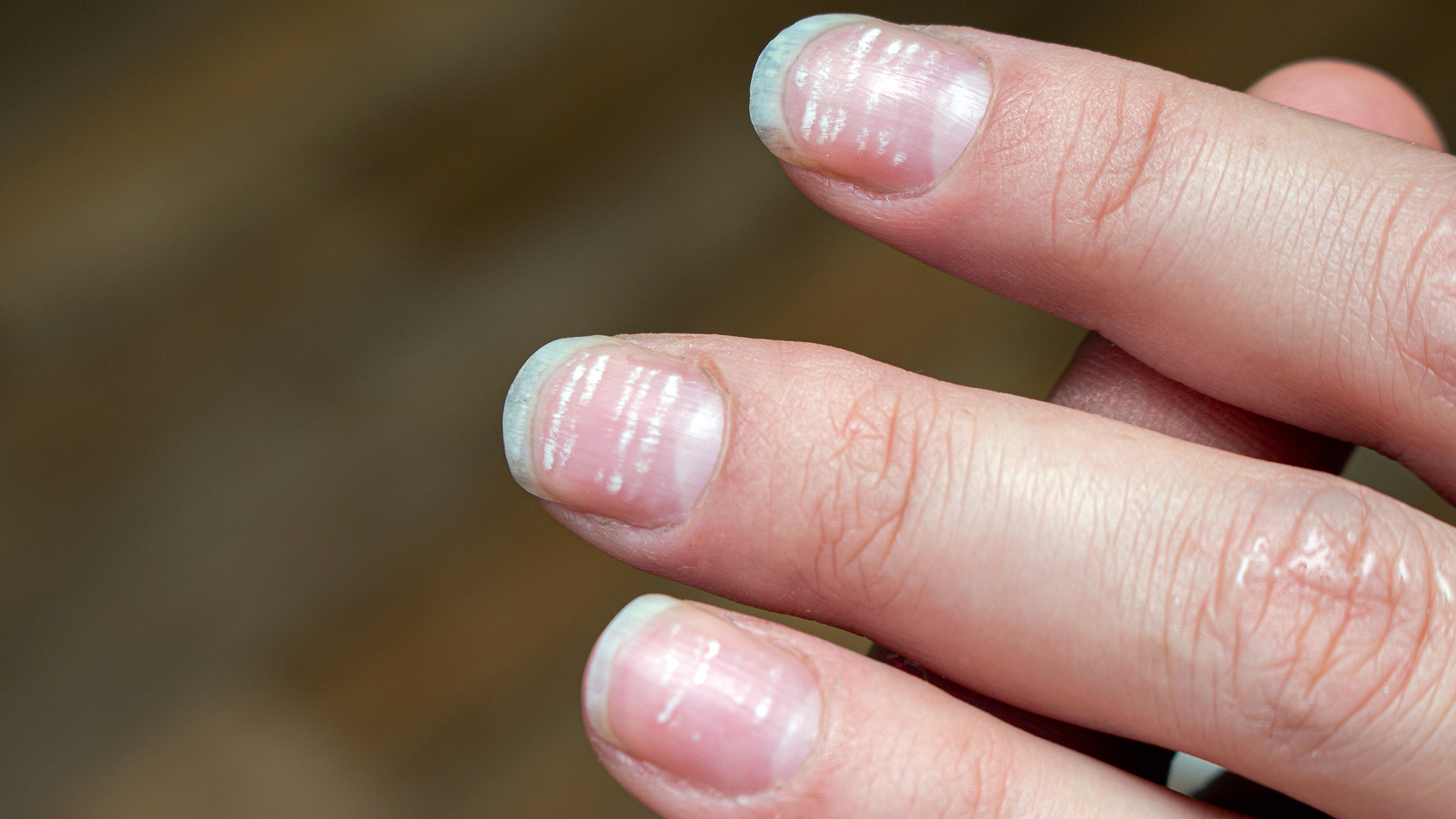 When Should I See a Doctor for Changes in My Nails? - GoodRx