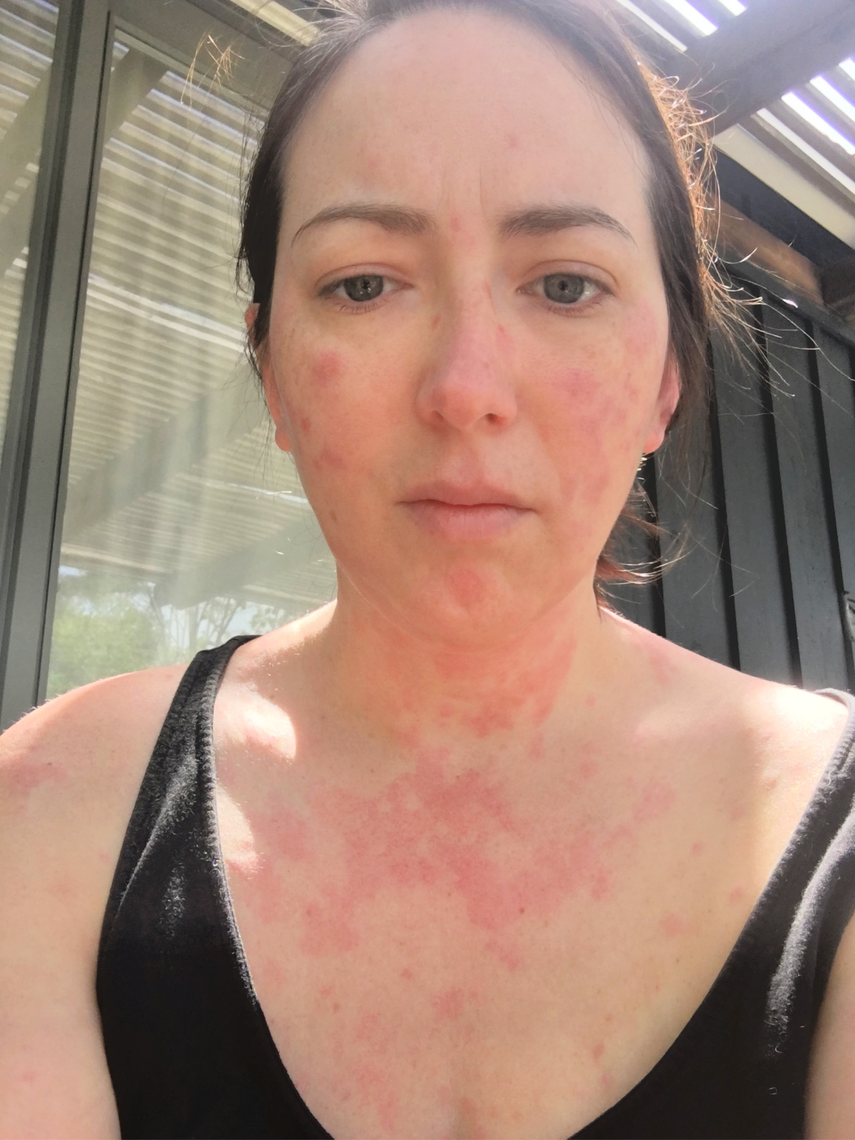 Jennifer Simmons is pictured in a selfie, showing her hives.