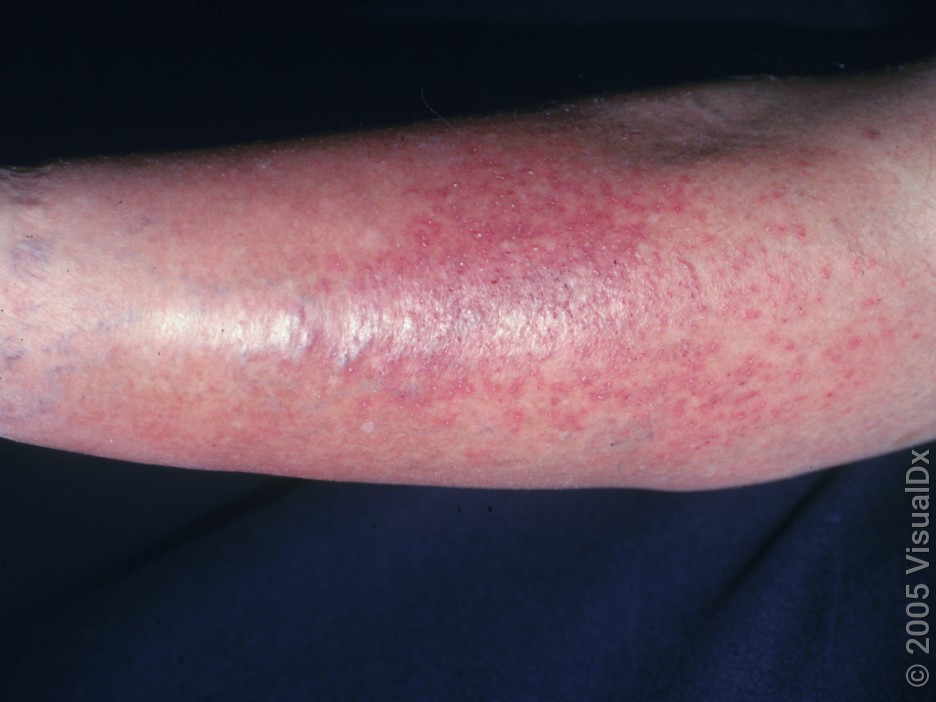 Varicose eczema  National Eczema Society