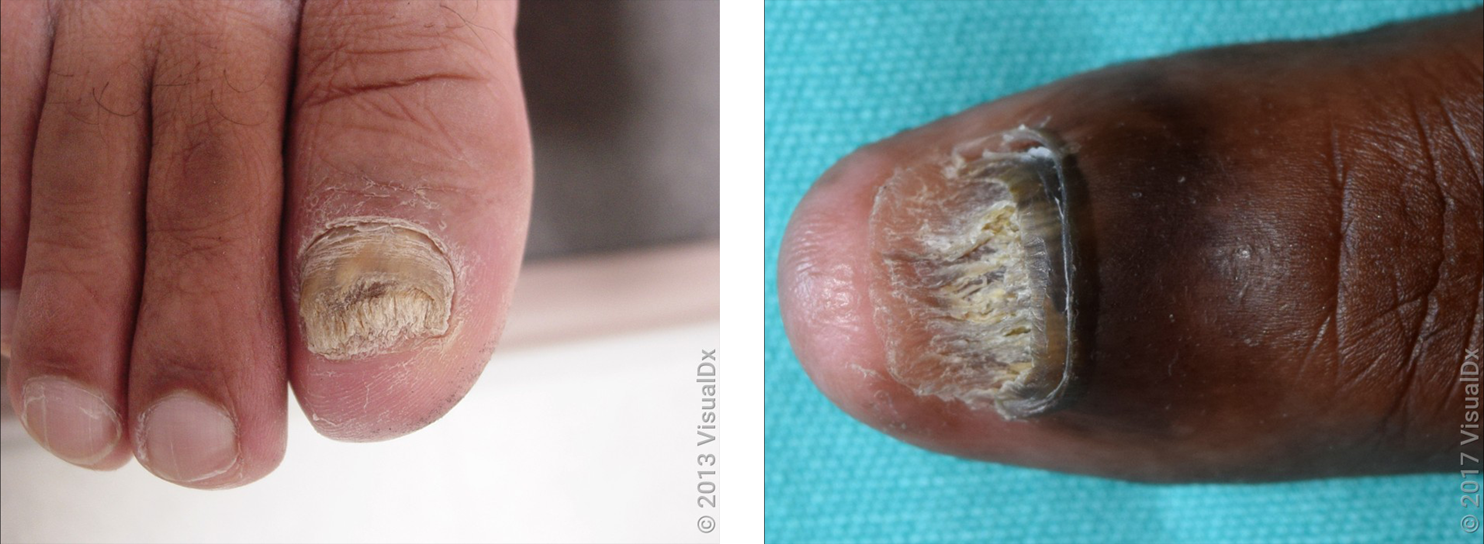 Twenty-nail dystrophy - Altmeyers Encyclopedia - Department Dermatology