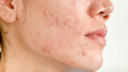 How To Get Rid Of Acne Scars Topical Treatments Surgery More GoodRx