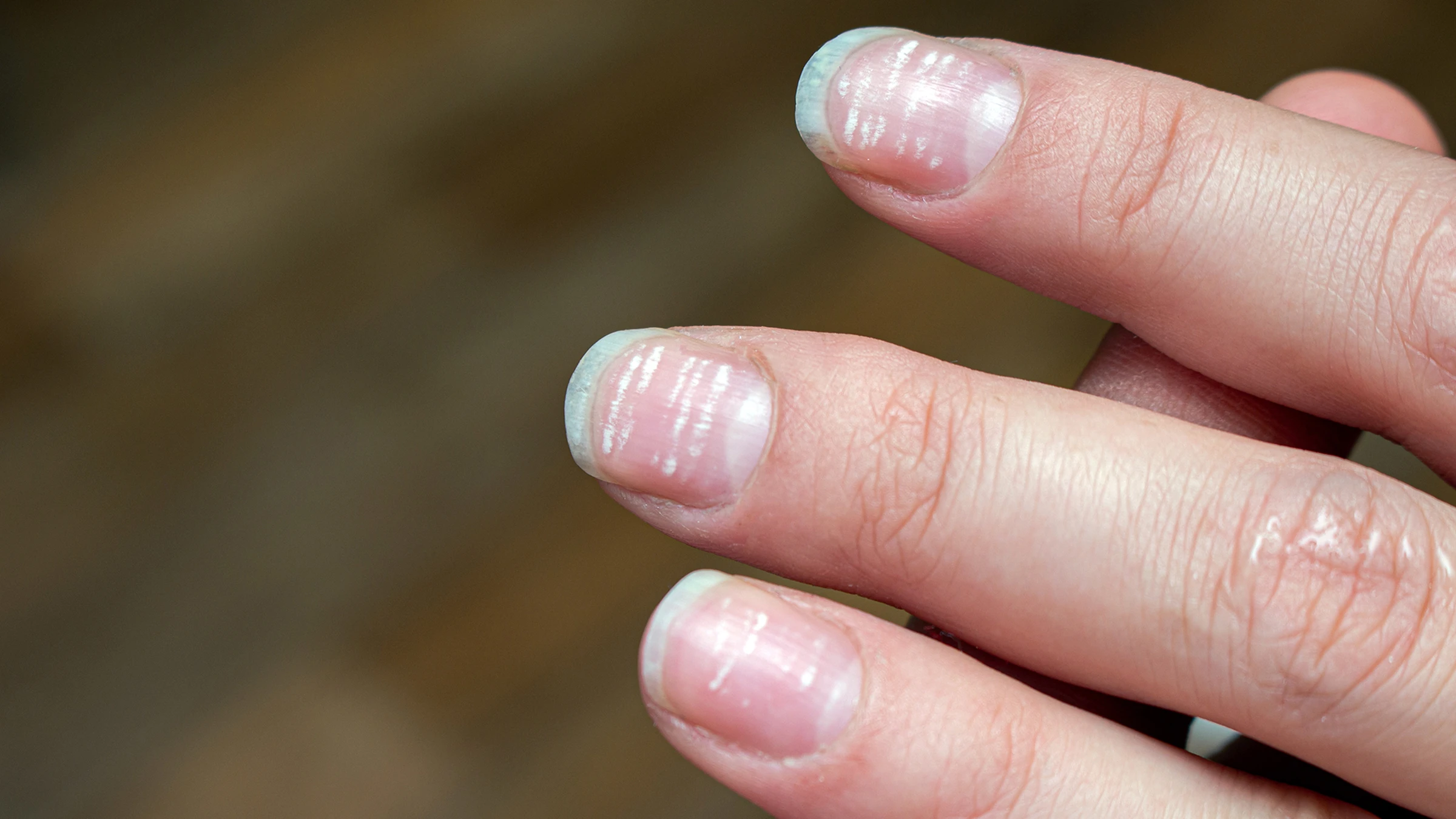 6 Signs of Vitamin Deficiency in Nails