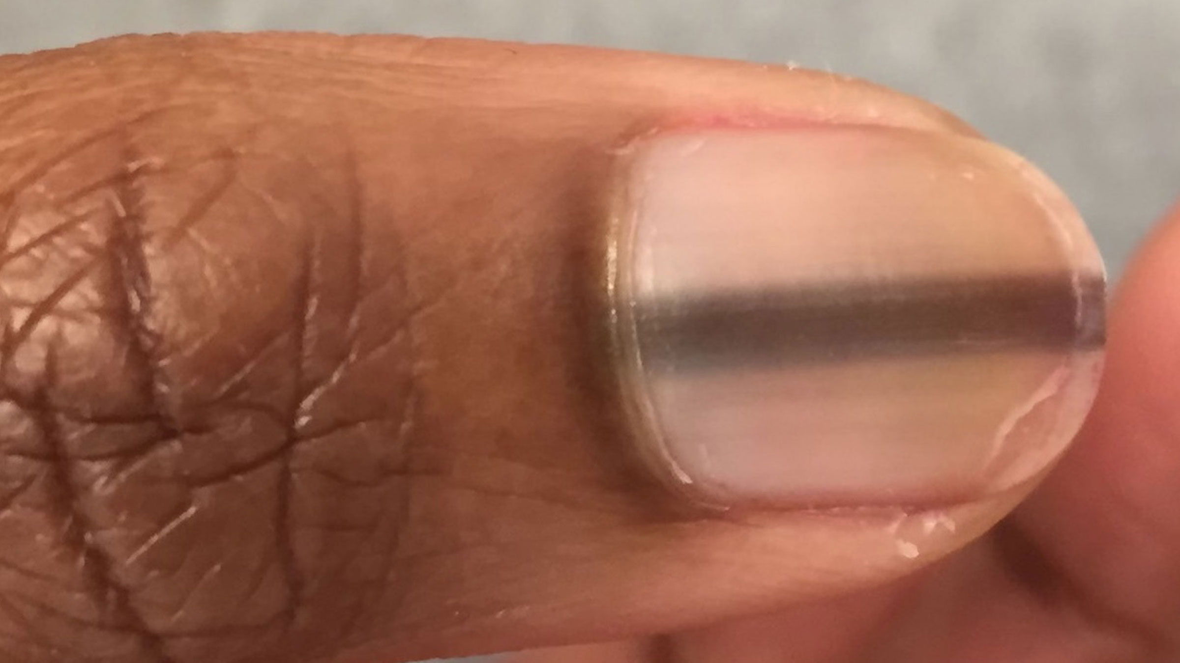 cancer on my finger