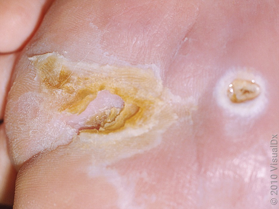A close-up look at the beginning stage of a diabetic ulcer and a full ulcer on the foot. 