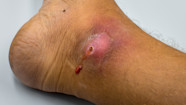 Figure From Post surgical Wound Management Of Pilonidal 47 OFF