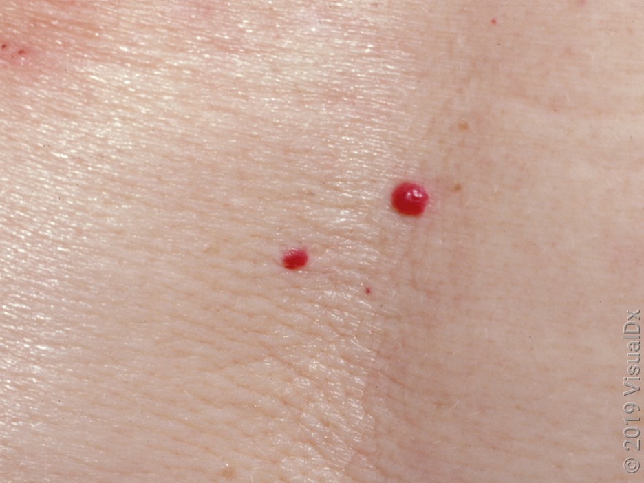 Cherry Angiomas: Causes, Symptoms, and Removal (With Images) - GoodRx