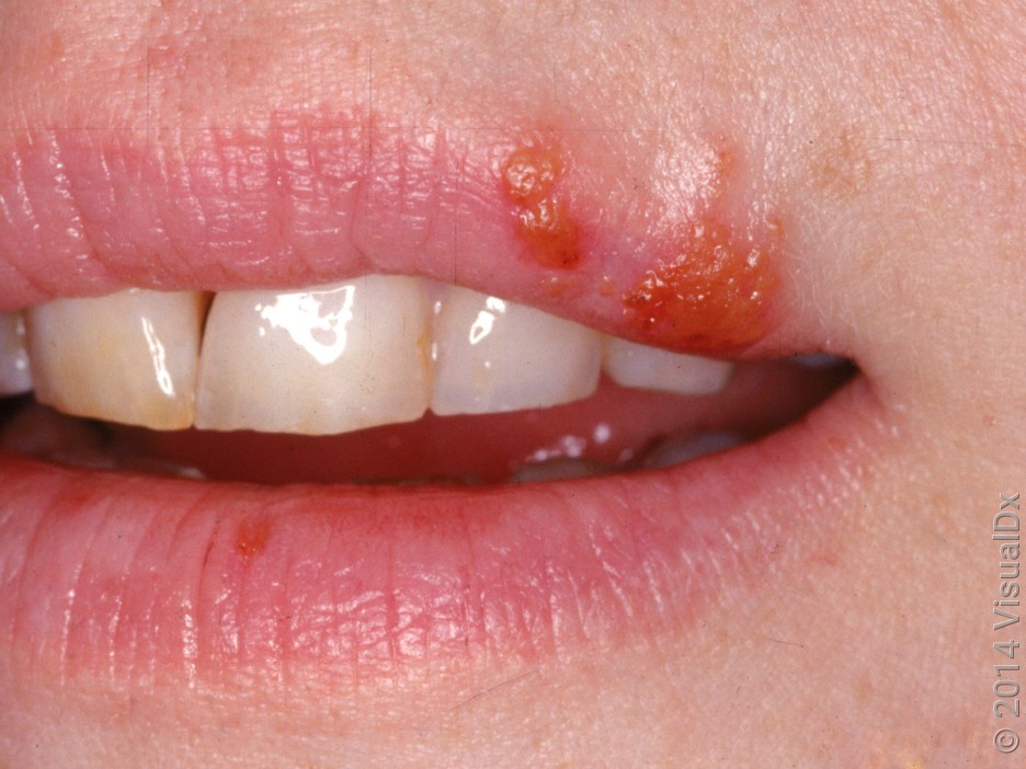 Close-up of a cold sore crusting over.