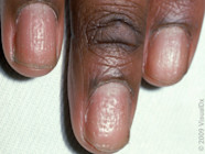 8 Ways Psoriatic Arthritis Affects The Nails GoodRx 8 Ways Psoriatic Arthritis Affects The Nails GoodRx