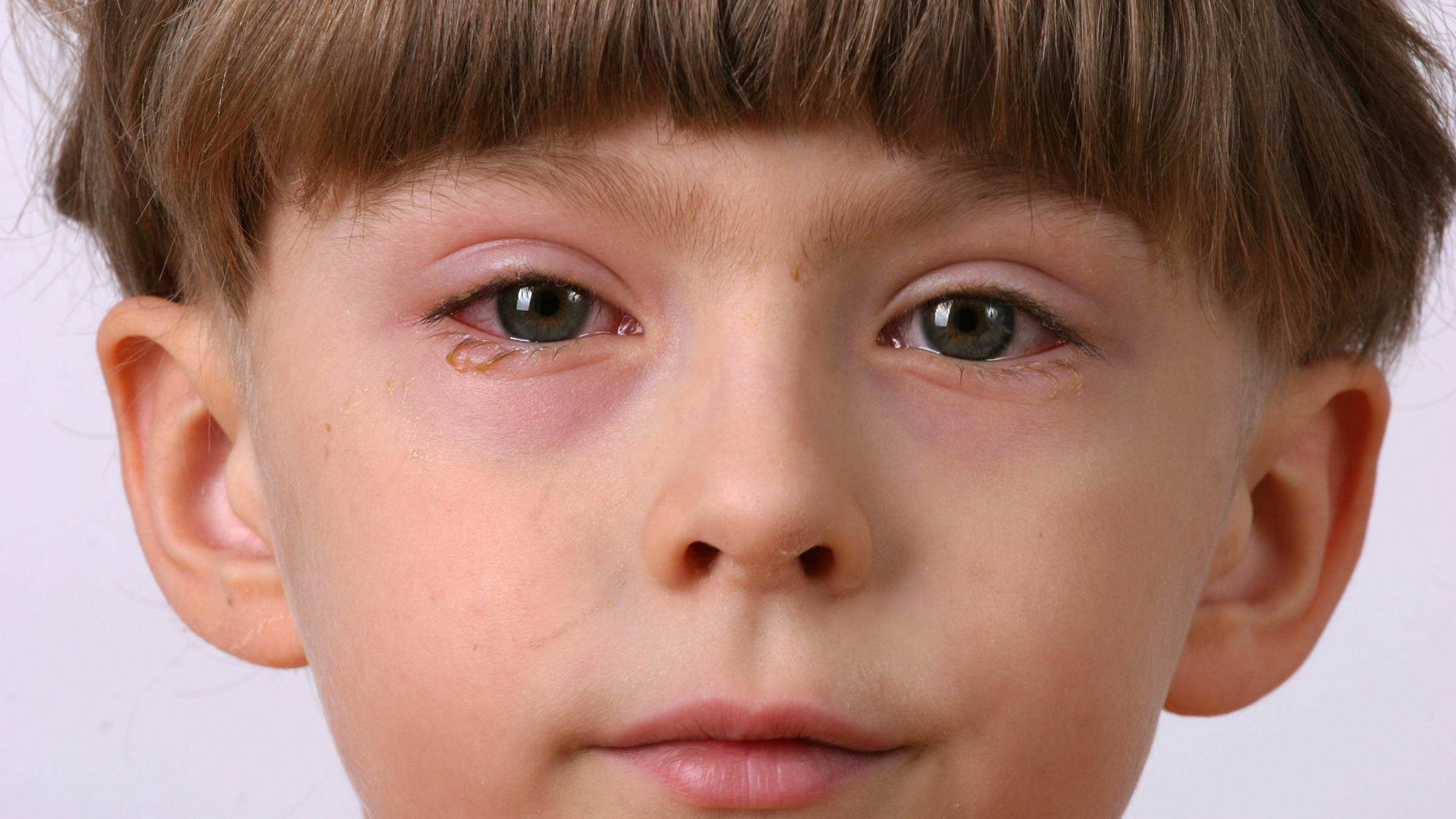 Young Boy With Pink Eye 145996939 