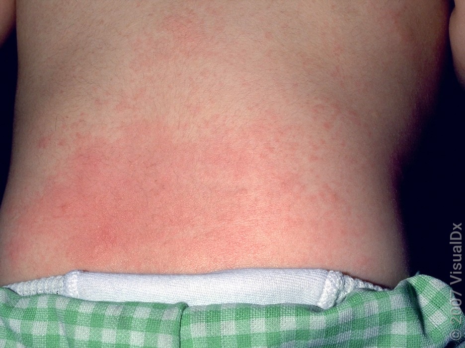 Close-up of many small, pink skin bumps and patches on the lower back in miliaria.