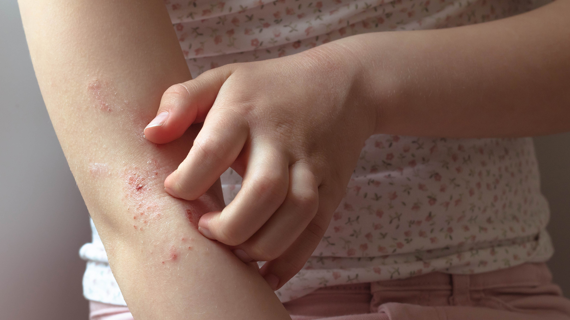 Scratching Eczema On Arm 1314008576 