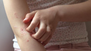 Is Eczema An Autoimmune Disease Causes Symptoms And Treatment GoodRx