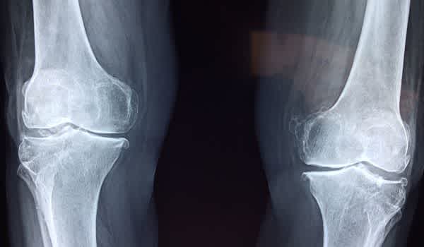 cms team model lower extremity joint replacement x ray