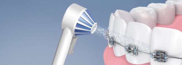 Los Mejores Irrigadores Dentales Para Ortodoncia article banner