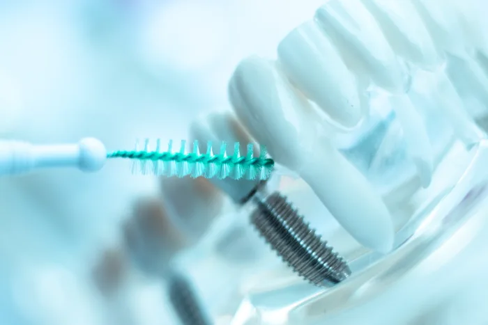 Cómo limpiar tus implantes dentales