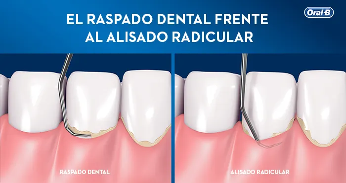 Article Dental Scaling Root Planning - 1