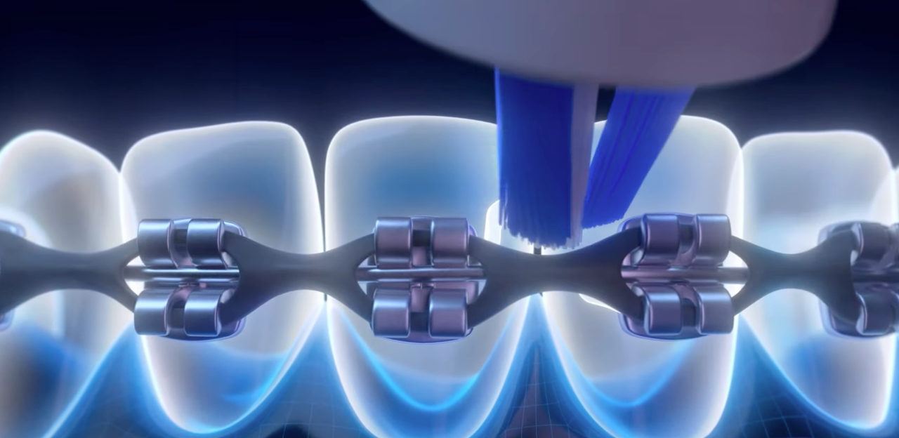 ¿Cuál Es El Mejor Cepillo De Dientes Eléctrico Para Brackets? article link