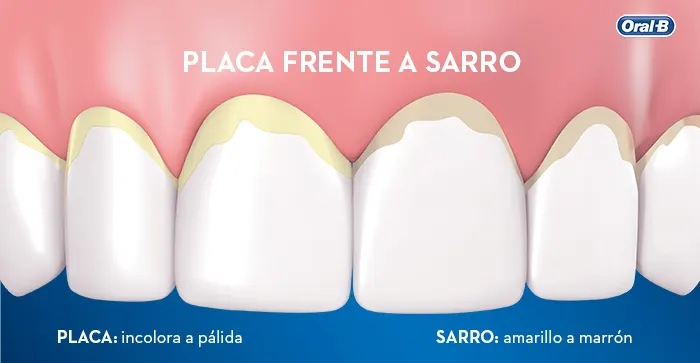 placa frente a sarro