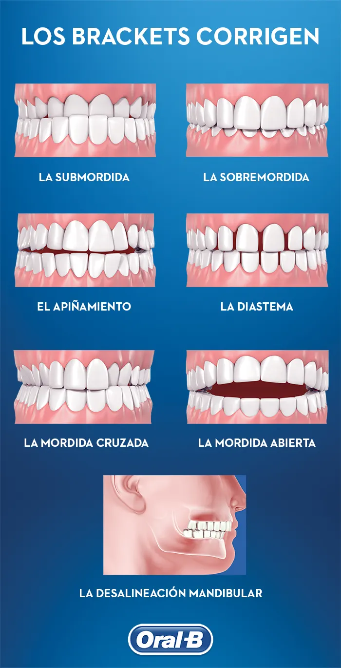 los brackets corrigen