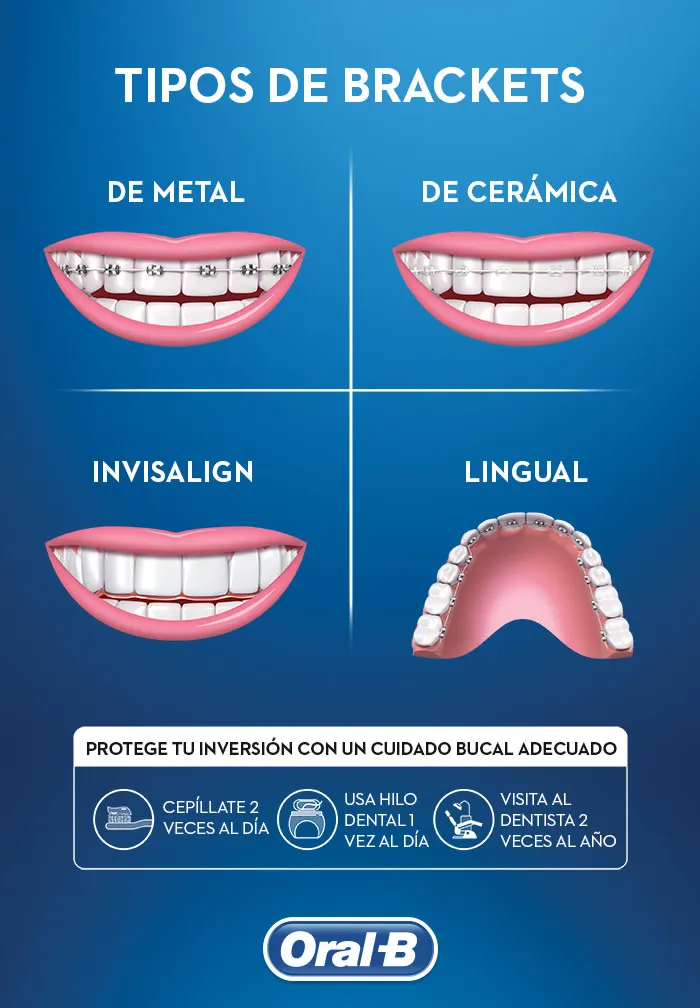 tipos de brackets