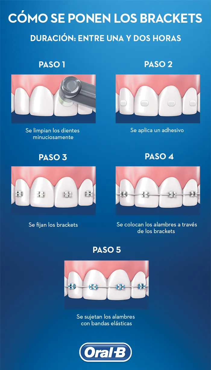 como se ponen los brackets