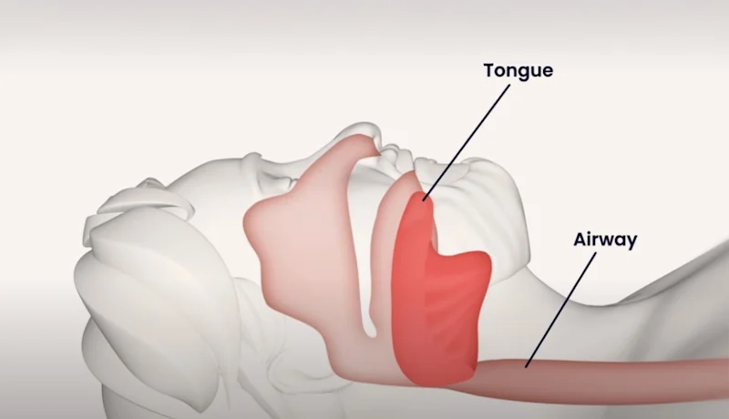 What is obstructive sleep apnea?