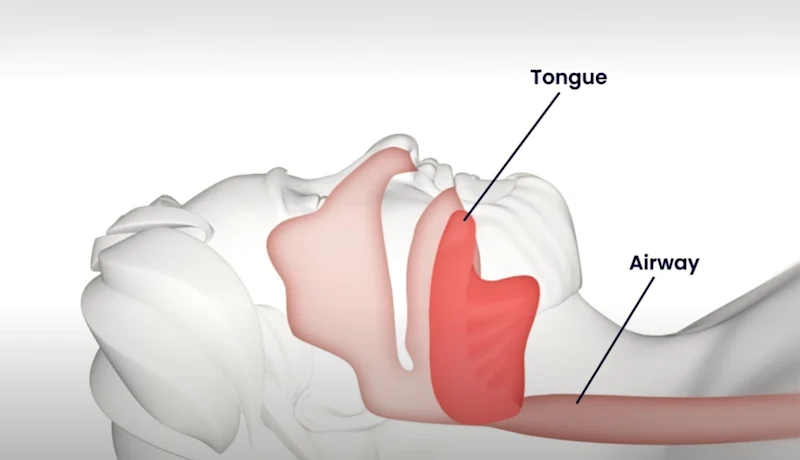 What is obstructive sleep apnea?