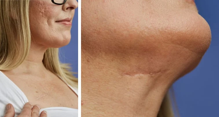 Patient Karen's scar 