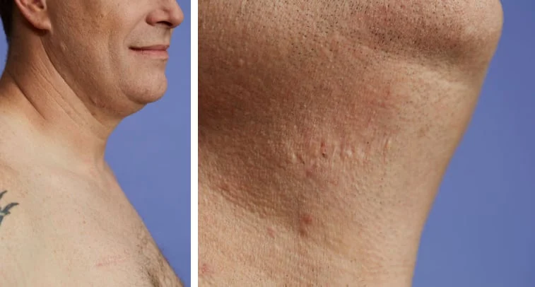 Patient James' scar 