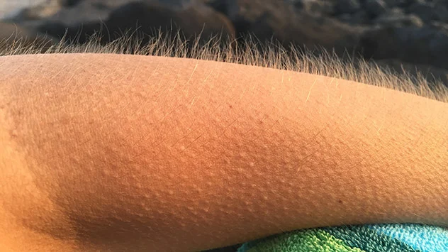 Gänsehaut auf einem Arm